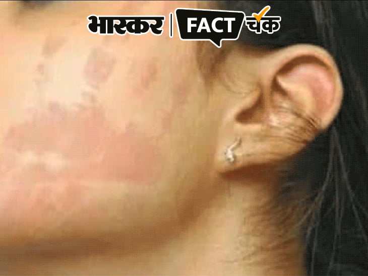 क्या थप्पड़ के बाद कंगना के गाल पर छपी उंगलियां:फोटो शेयर कर यूजर्स ने ट्रौल किया; जानिए वायरल PHOTO का सच