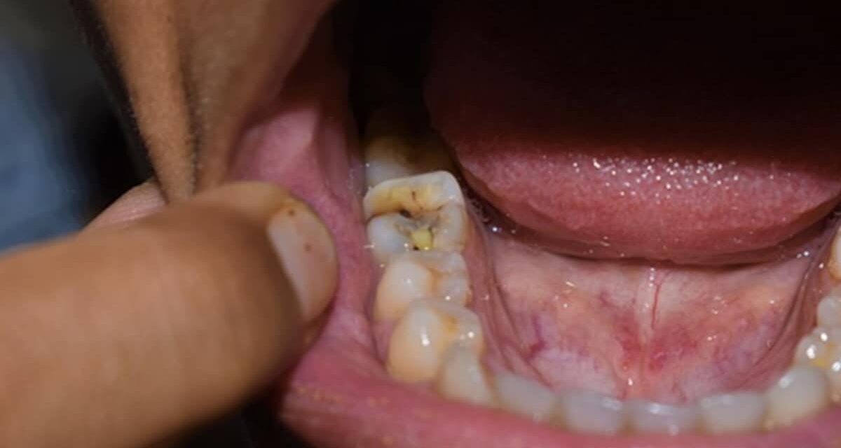 Toothache : बस ये एक छोटा सा करना है काम, दांत के दर्द, पीलेपन और कीड़े से मिलेगा छुटकारा