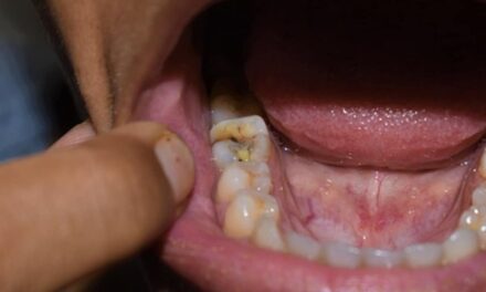 Toothache : बस ये एक छोटा सा करना है काम, दांत के दर्द, पीलेपन और कीड़े से मिलेगा छुटकारा