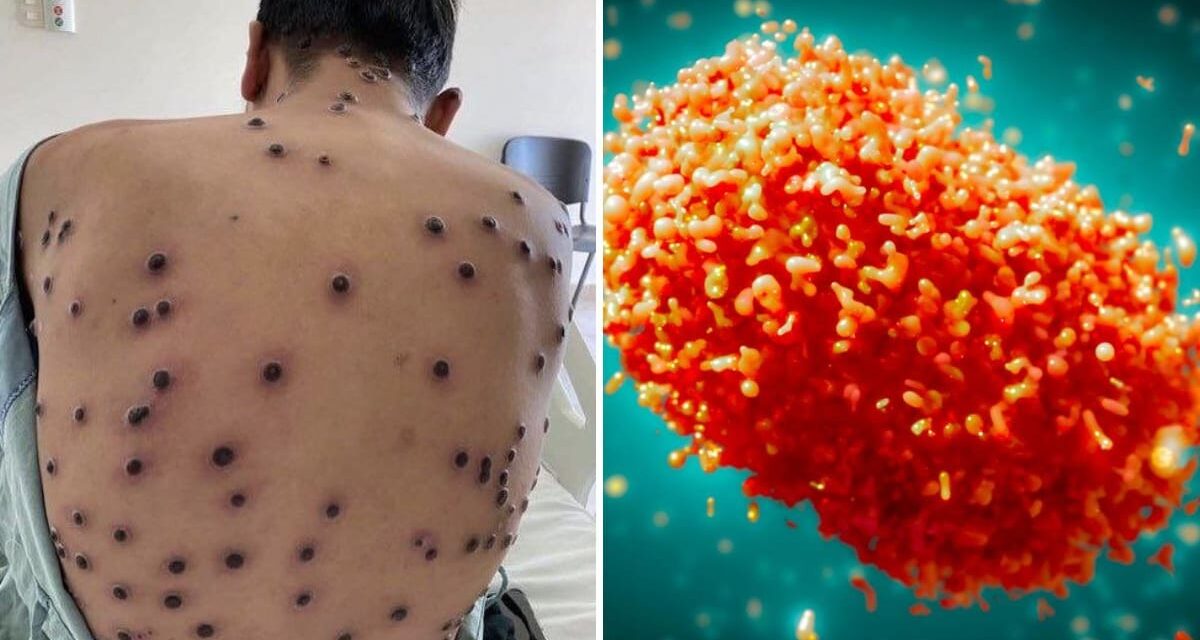 तेजी से फैल रहा एमपॉक्स, डब्ल्यूएचओ फिक्रमंद, डॉक्टर ने बताया क्या हैं लक्षण और कैसे करें बचाव