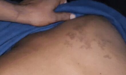 गुप्तांग में मिर्ची डाली, थाने में उल्टा लटकाकर पीटा:छतरपुर में चार युवकों का पुलिस पर आरोप; कहा