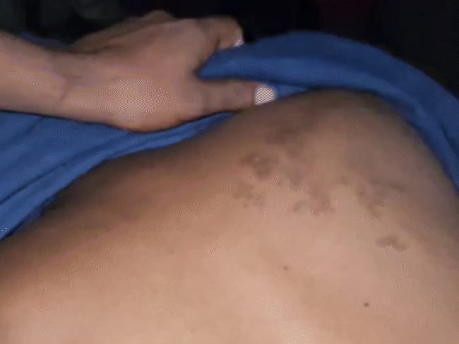 गुप्तांग में मिर्ची डाली, थाने में उल्टा लटकाकर पीटा:छतरपुर में चार युवकों का पुलिस पर आरोप; कहा
