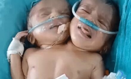 इंदौर में जन्मी दो सिर एक धड़ वाली बच्ची:दो लिवर, एक दिल, दो फेफड़े; डॉक्टर बोले
