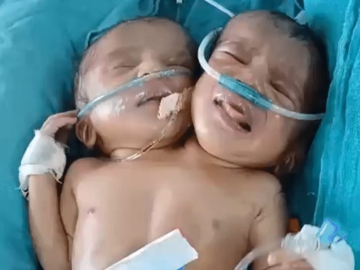 इंदौर में जन्मी दो सिर एक धड़ वाली बच्ची:दो लिवर, एक दिल, दो फेफड़े; डॉक्टर बोले